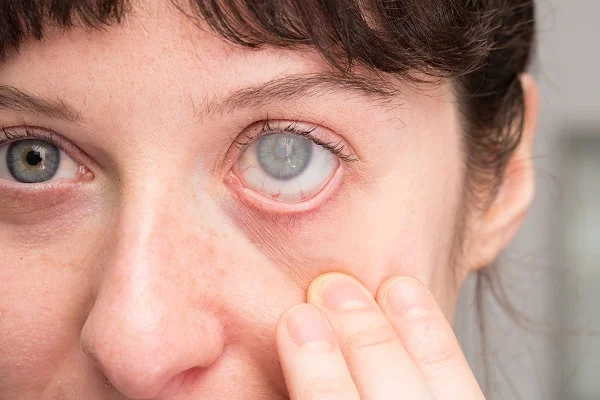 GLAUCOMA SERVICES